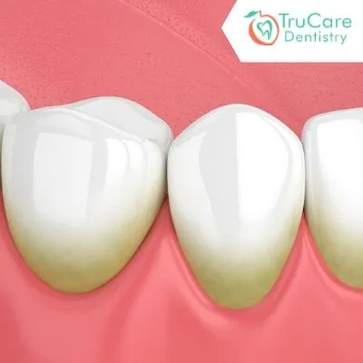 How to prevent tartar buildup
