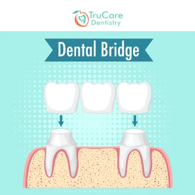 How is a cantilever dental bridge different from other bridges
