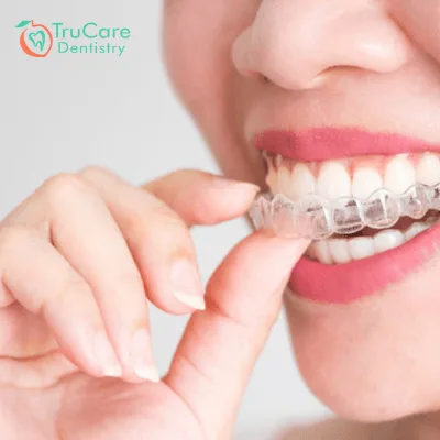 Invisalign braces time taken