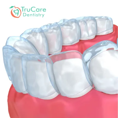 Benefits of Invisalign