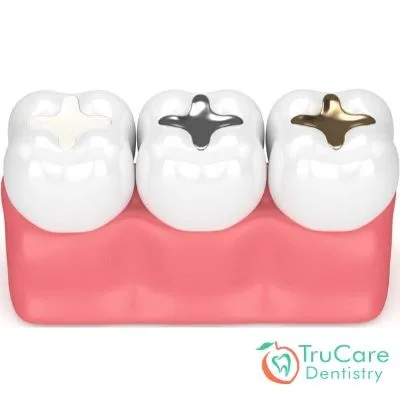 Is replacing amalgam fillings with tooth-colored composite a complicated procedure