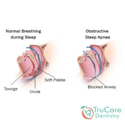 Is snoring one of the signs of sleep apnea