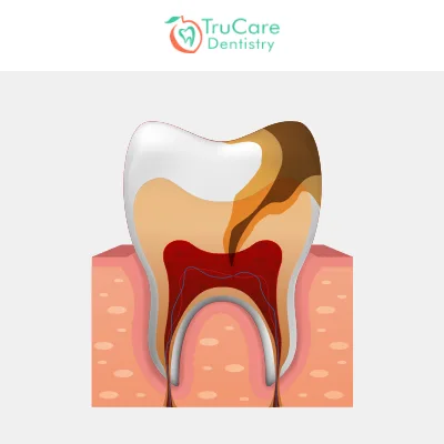 Tooth Pulp Infection Reversible with Medicines And Root Canal