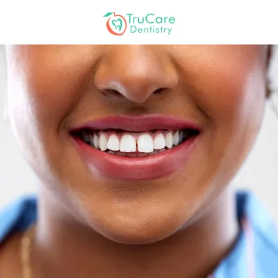 Everything You Need to Know about Craze Lines on Front Teeth