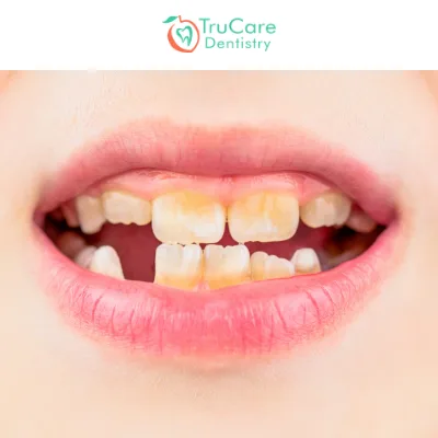 Lesion teeth