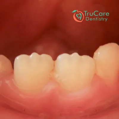 Mamelons on Teeth