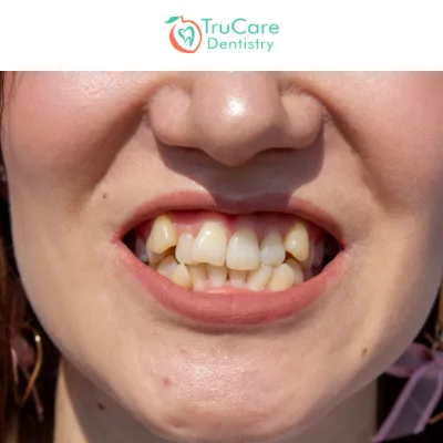 Misaligned Teeth Types Causes and Treatments