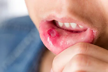 Oral Cancer_trucare