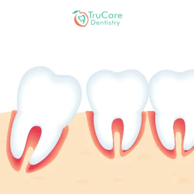 Treatment Options for Condensing Osteitis in Roswell & Marietta, Georgia
