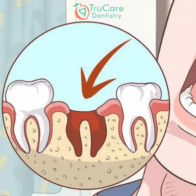Tooth Extraction Treatment