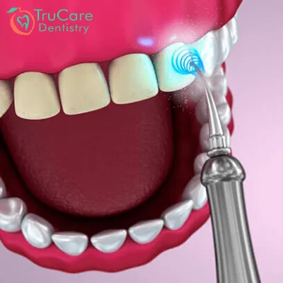 Periodontal Care in Roswell Georgia