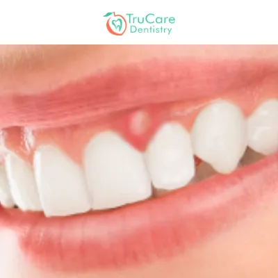 Periodontal Disease