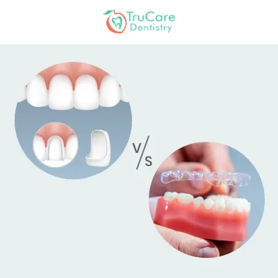 Porcelain Veneers or Invisalign