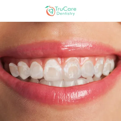 Post Braces Stains On Teeth Cause And Treatment