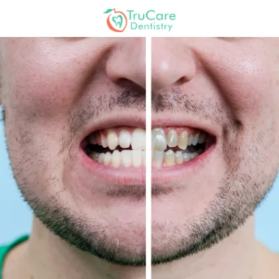 Reasons for Teeth Shift and Available Treatments