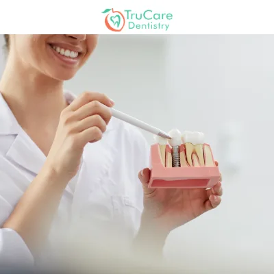 Reasons to Consider Dental Implants