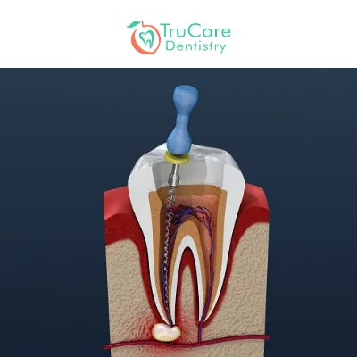 Root Canal Or Alternative Treatment