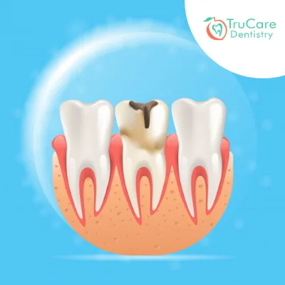 Root Canal Treatment in Roswell GA