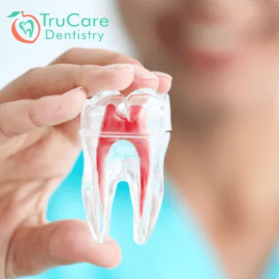 Root canal Treatment