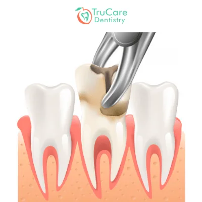 Save Your Tooth Or Pull It Which One Is Ideal