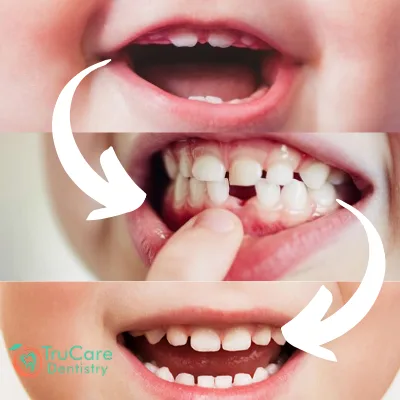 Stages of Teething