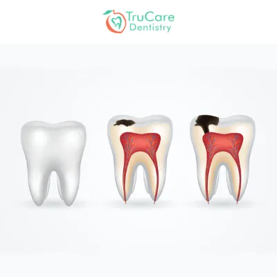 Stages of tooth decay