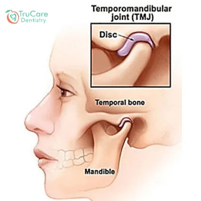 TMJ Disorder