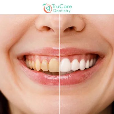Teeth Erosion What Is It and How You Can Prevent It