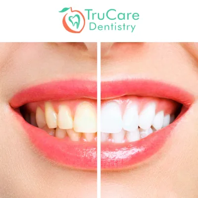 Teeth Whitening Mistakes to Avoid