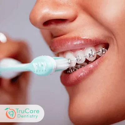 Teeth staining Invisalign Braces treatment