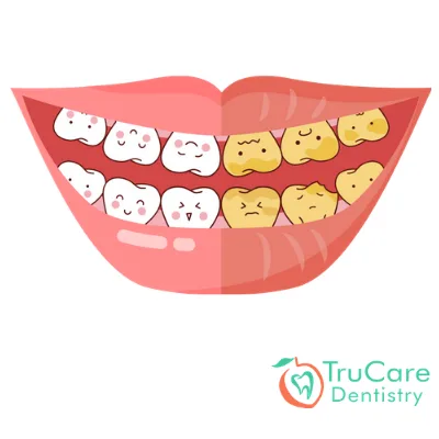 Teeth whitening