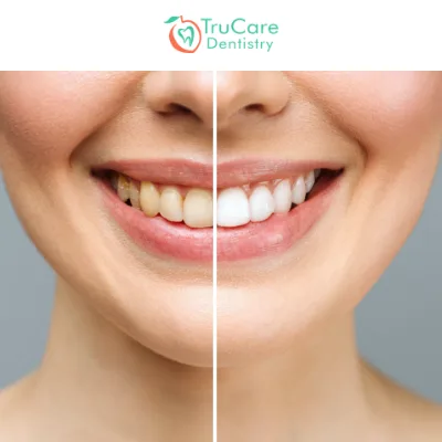 Teeth whitening