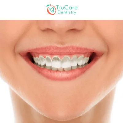 The Causes Of Green Teeth And Here’s How To Treat