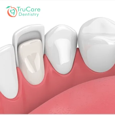 The Evolution of Dental Veneers Over Time