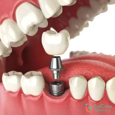 Things That You Can do For Missing Teeth
