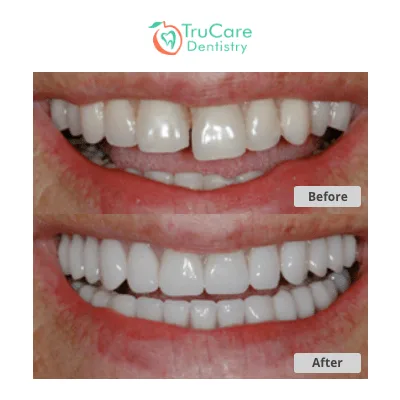 Tooth reshaping