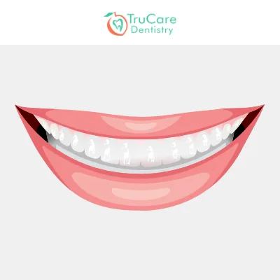 Transparent teeth