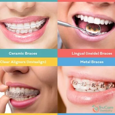Types of Braces and which one is the best for you