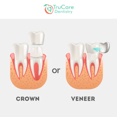Veneers or Crowns: Which Is Right For Me