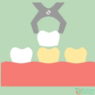 Veneers and Lumineers