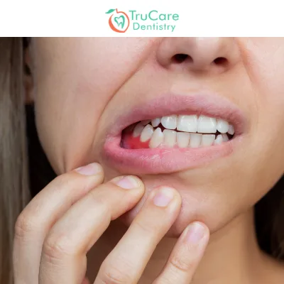 What Is Gum Boil? Explore Causes, Symptoms, and Treatment