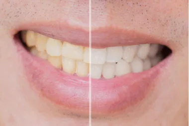 What Triggers Tooth Discoloration Which Habits Can Help In Avoiding Teeth Stains