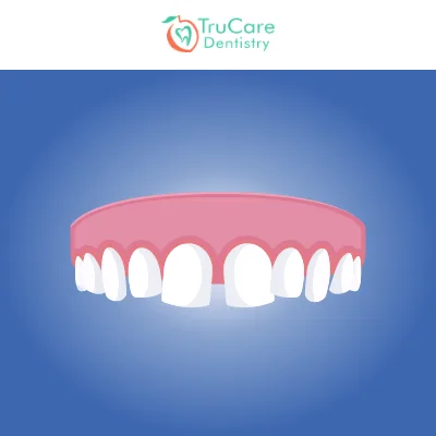 Which is the best option for filling spaces between teeth