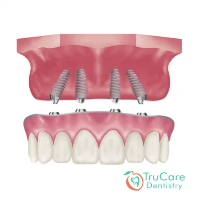 all on four dental implant