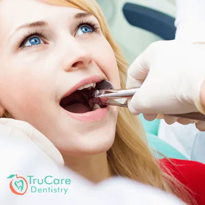 Tooth Extraction in Roswell & Marietta, Georgia