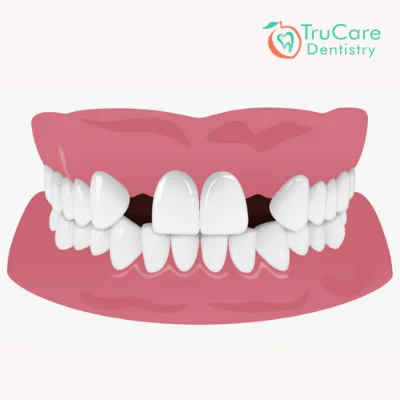 gap between teeth