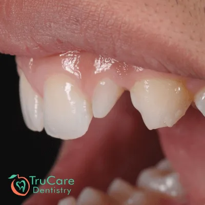 peg shaped teeth