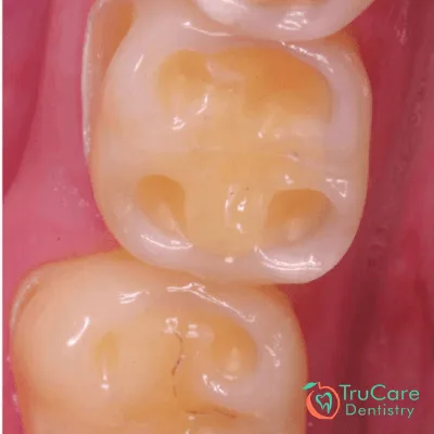 tooth cupping