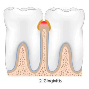 gum disease Treatment Roswell GA