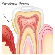Periodontal Treatment Roswell GA